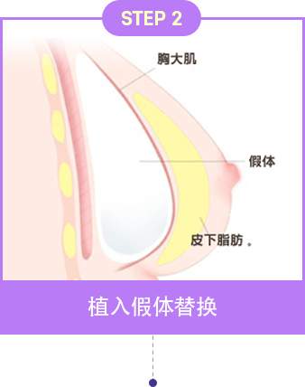 波兰综合征乳房矫正