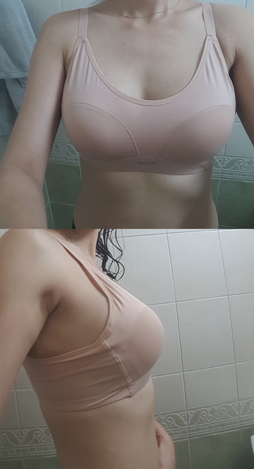 MD 手术案例
