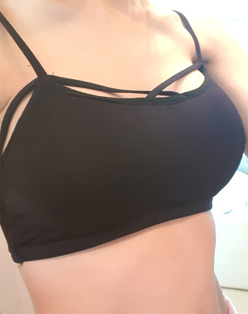 MD 手术案例