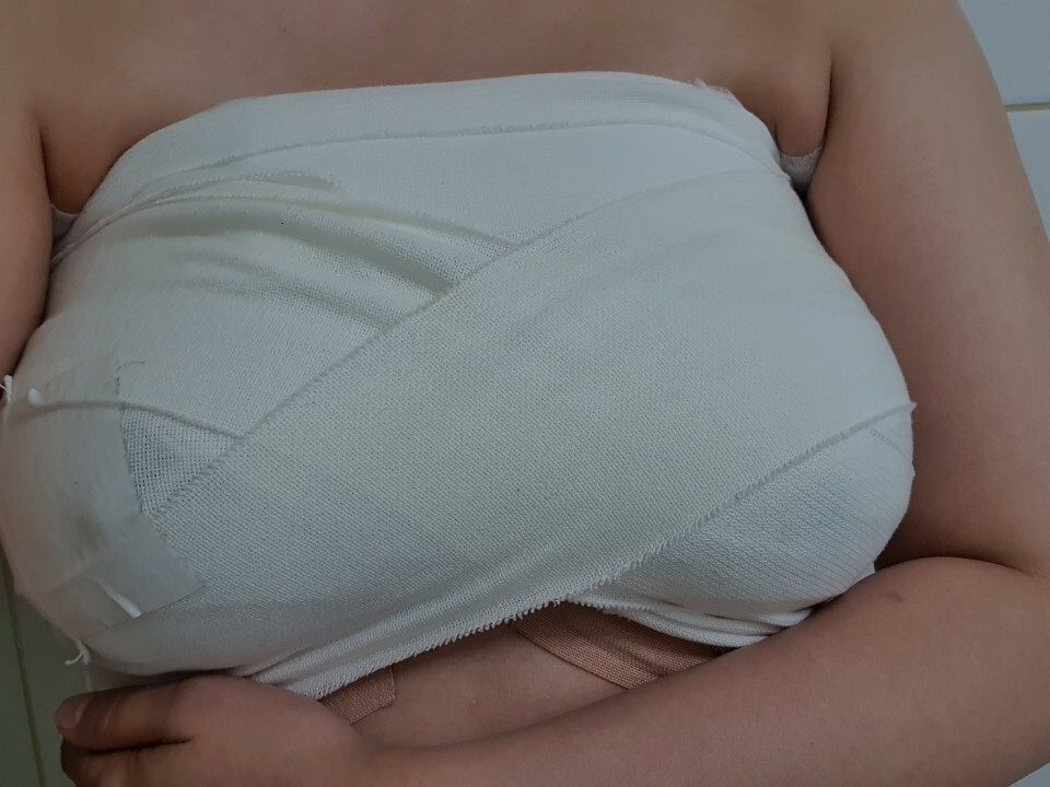 MD 手术案例