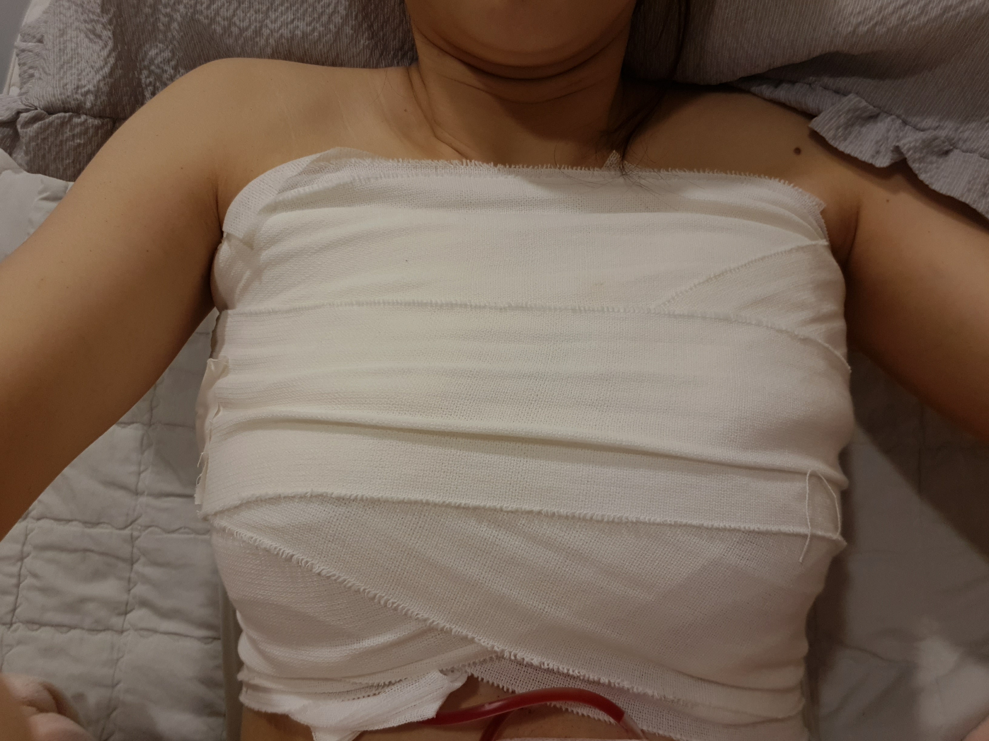 MD 手术案例