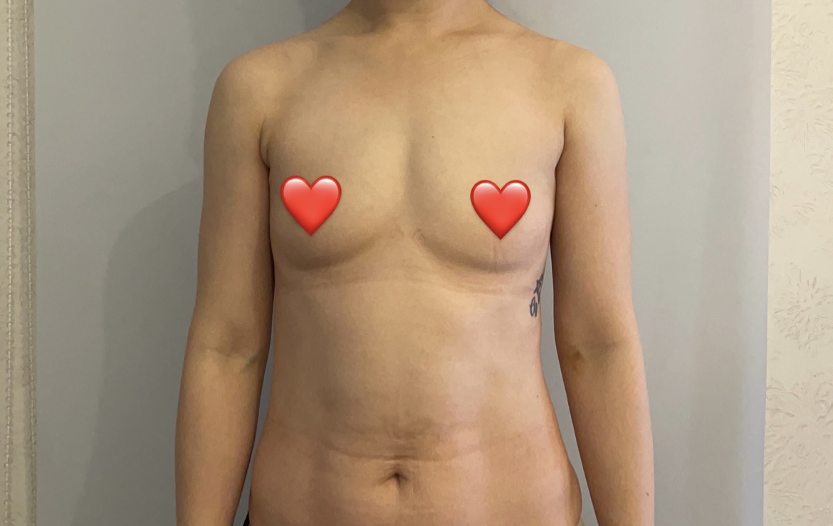 MD 手术案例