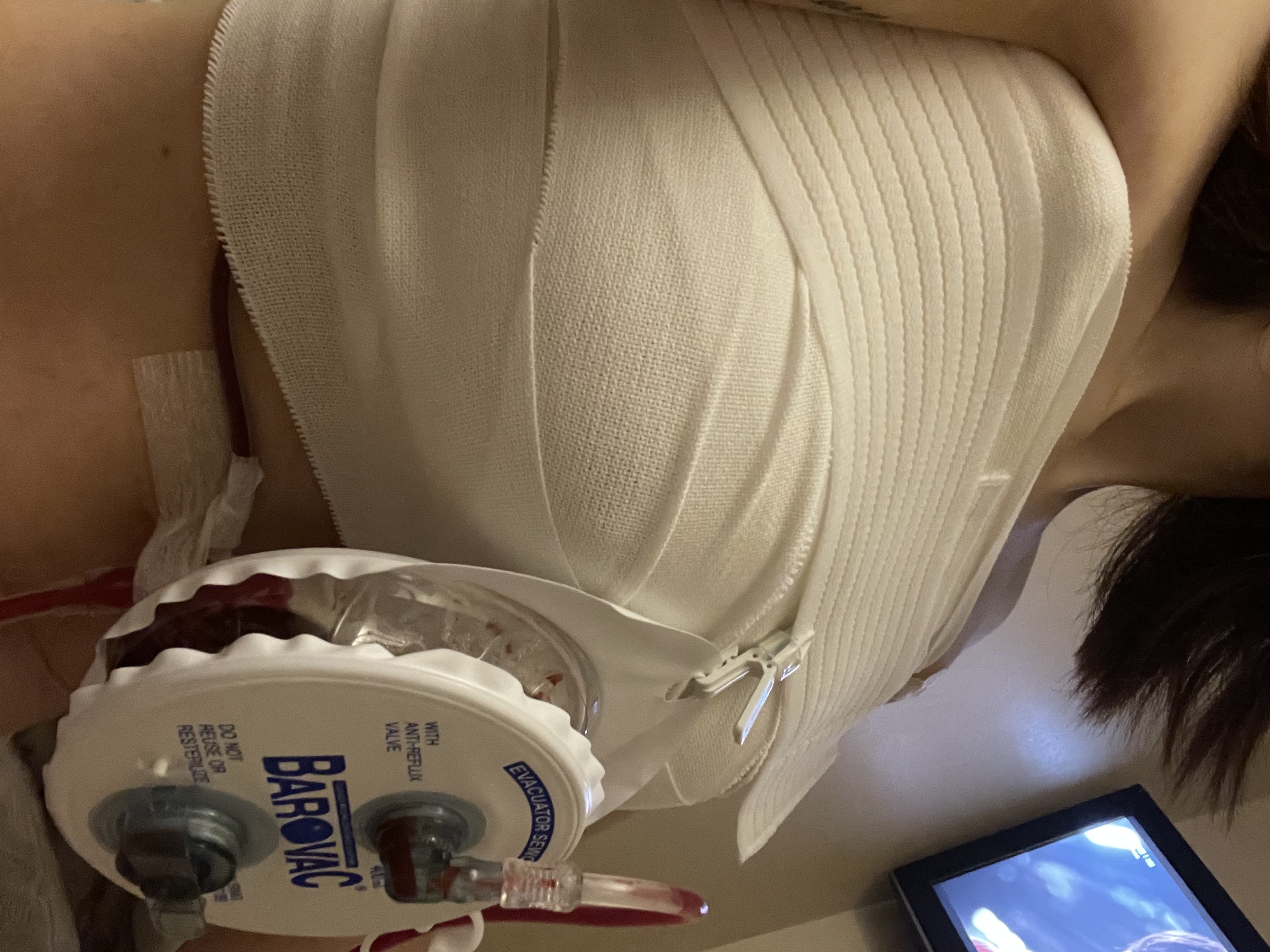 MD 手术案例