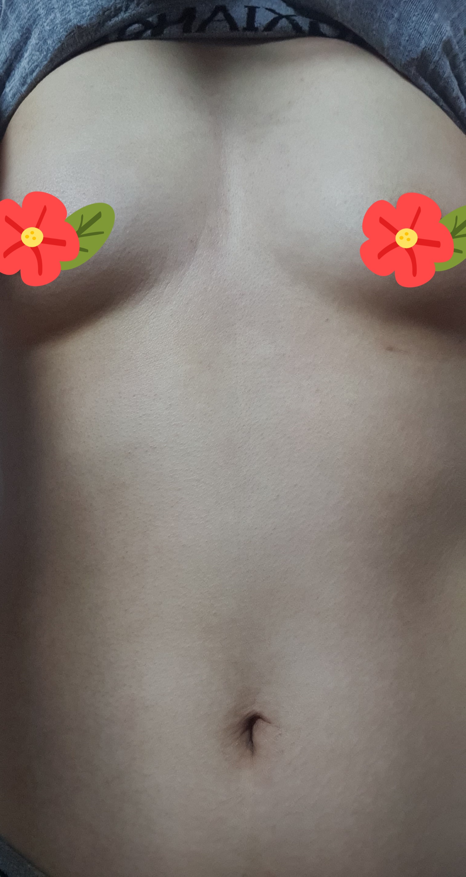 MD 手术案例