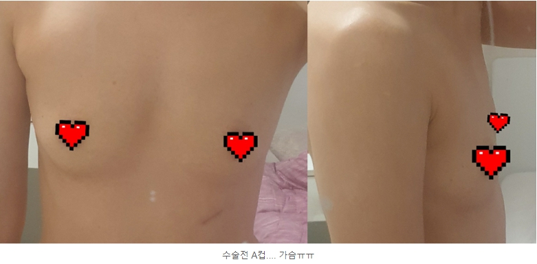 MD 手术案例