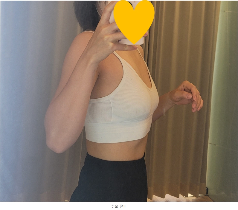 MD 手术案例