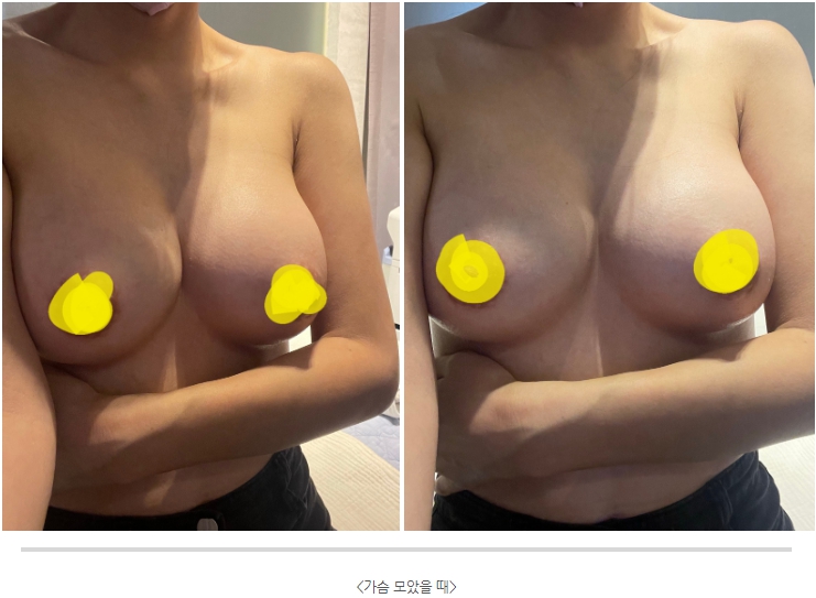 MD 手术案例