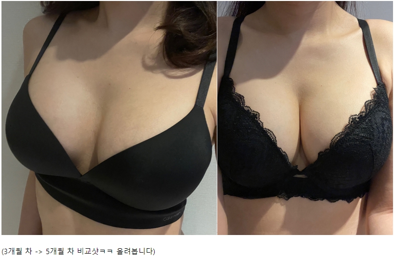 MD 手术案例