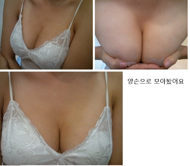 MD 手术案例