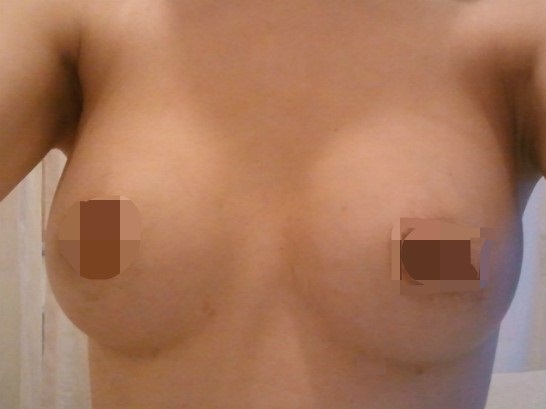 MD 手术案例