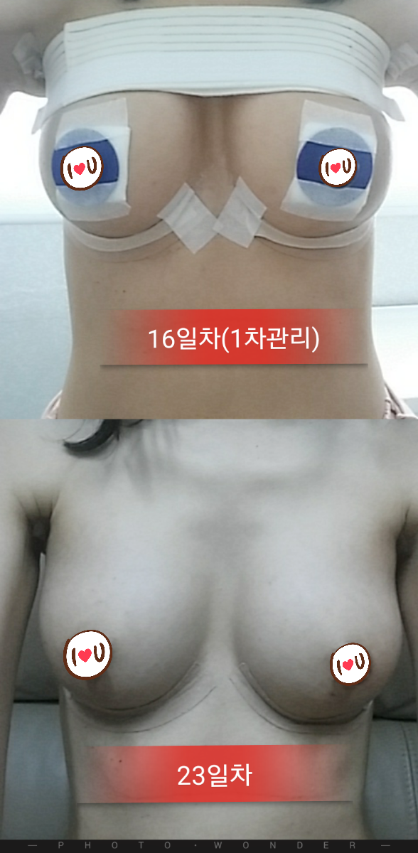 MD 手术案例
