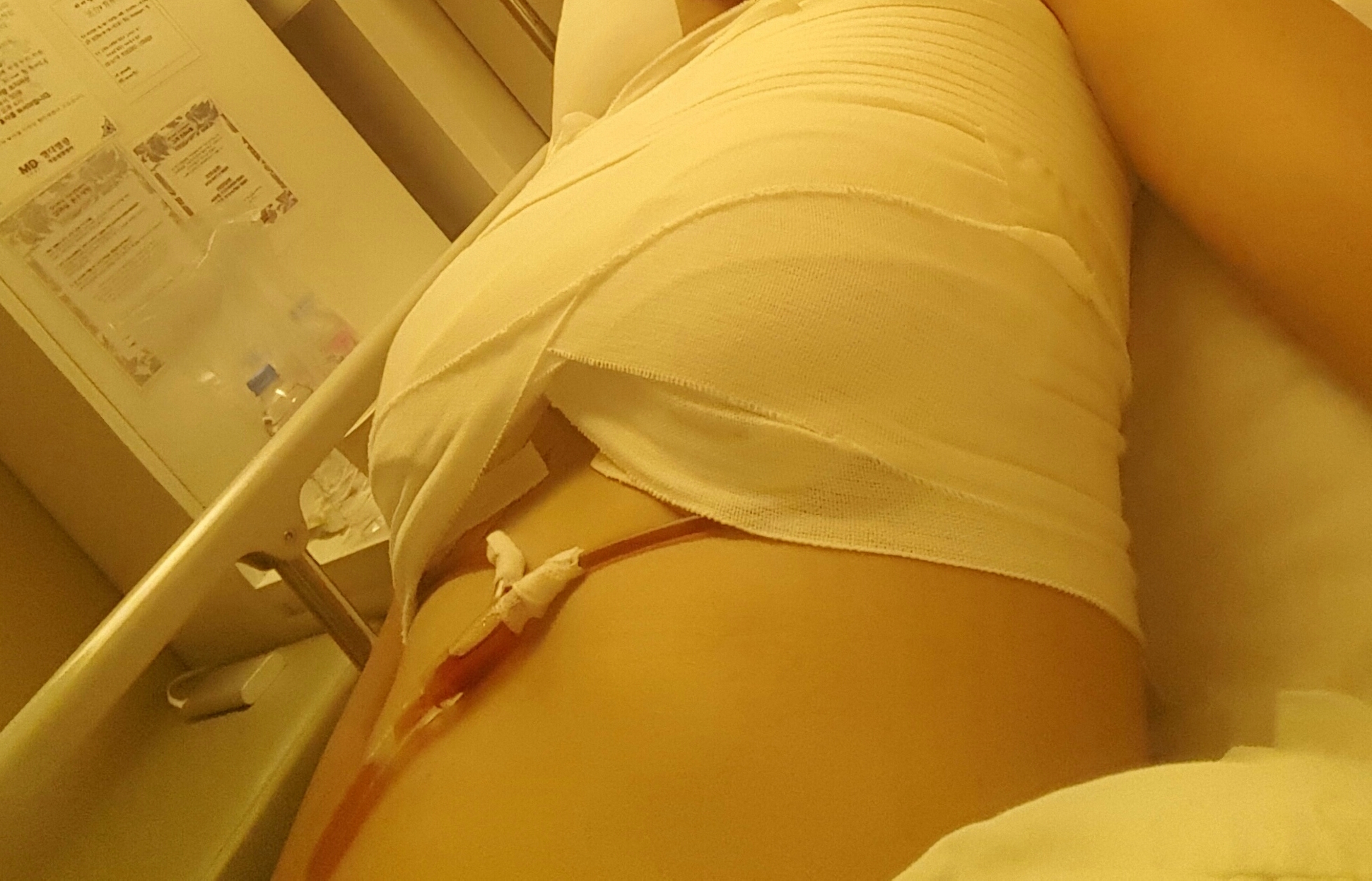 MD 手术案例