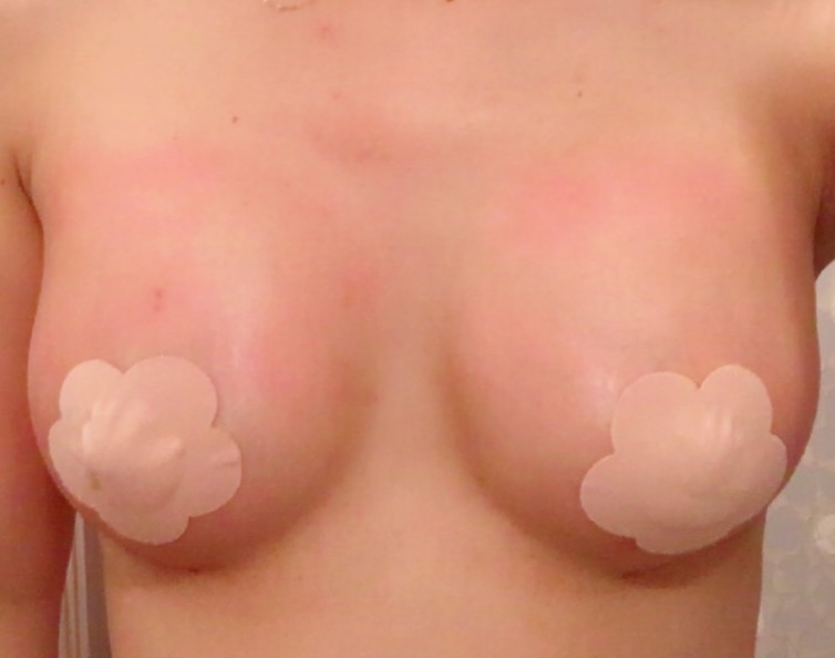 MD 手术案例