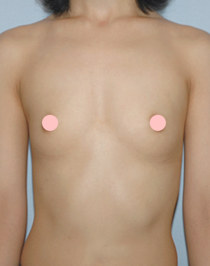 MD无血胸部整形
