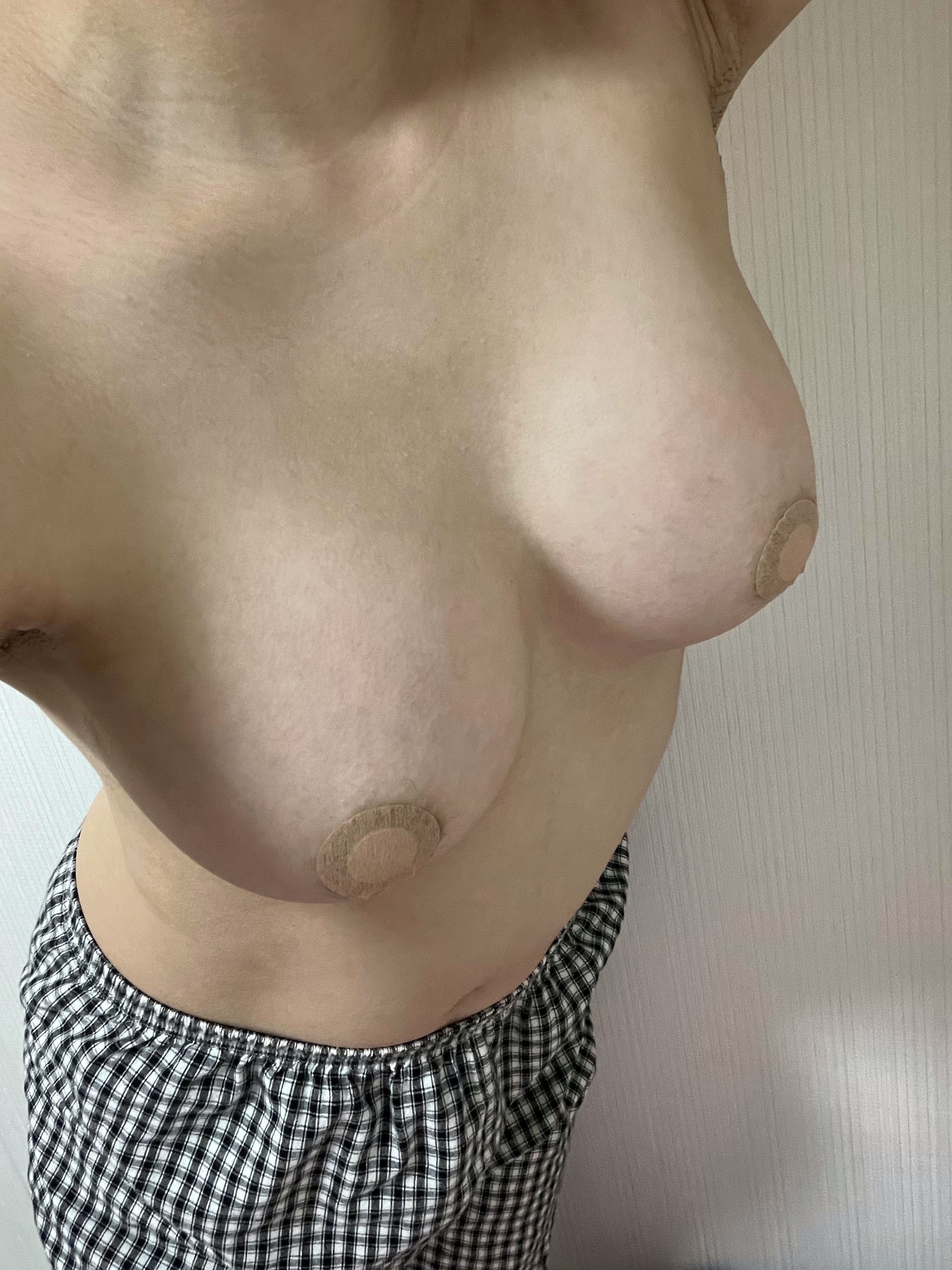 MD 手术案例
