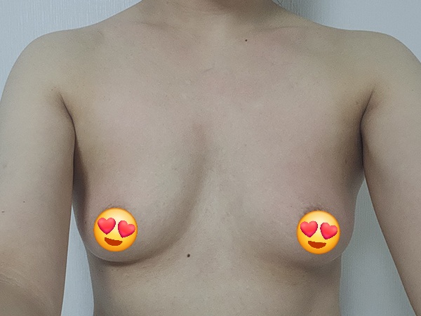 MD 手术案例