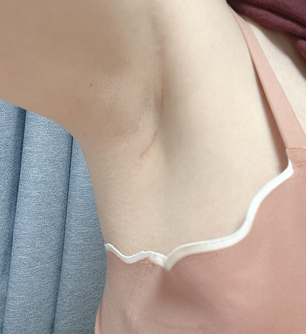 MD 手术案例