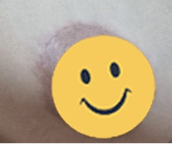 MD 手术案例