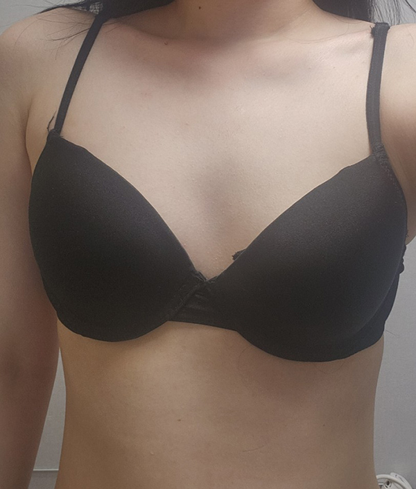 MD 手术案例